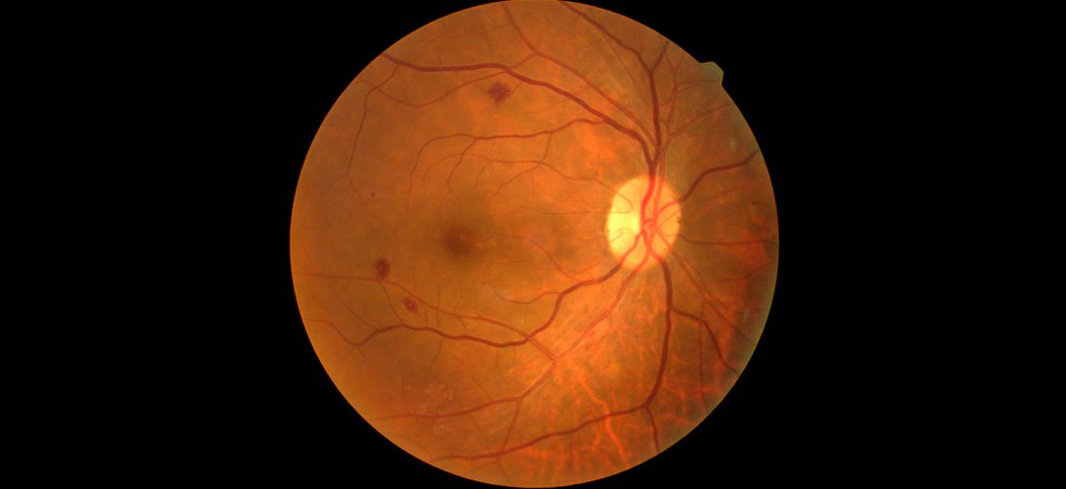 retinopathy.jpg
