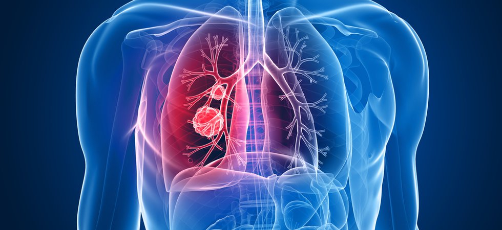 lung cancer.jpg