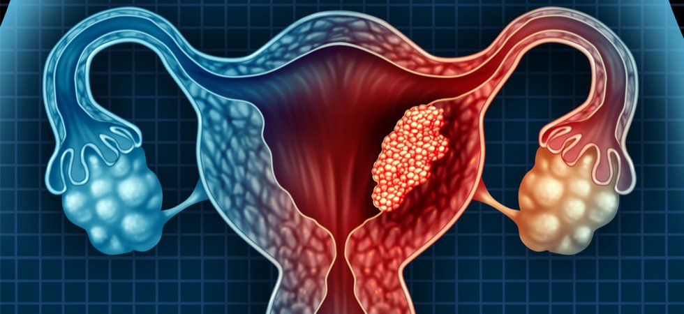 endometrial cancer.jpg