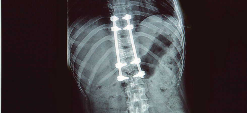 spinal implant.png
