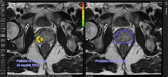 Prostate cancer found by Pi copy.jpeg